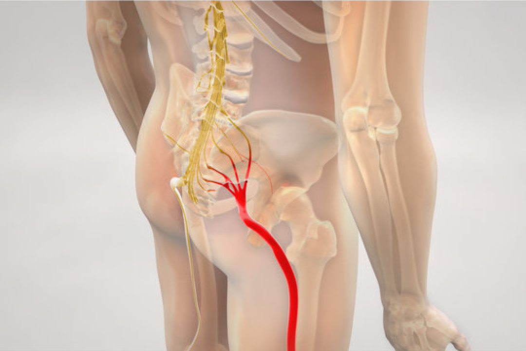 Sciatica